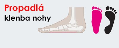 Propadlá klenba nohy – příznaky, léčba a tipy na vhodnou obuv | ARNO.cz - obuv s tradicí